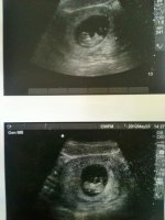 Ultrasound 10w6d.jpg