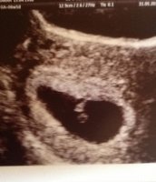 ultrasound 6w5d.jpg