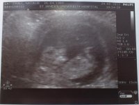 Our Little Miracle 1.jpg