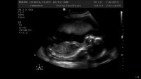 20week3day scan.jpg