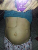 liver scar 001.jpg