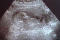 ultrasound aug 23.jpg