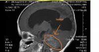 B tumor side view.jpg
