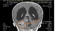 B tumor view.jpg