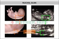 nuchal_scan_translucency_down_syndrome_test_pregnancy_ultrasound.jpg