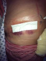 blistered hip 28 sep 12.jpg
