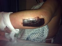 bloody arm 28 sept 12.jpg