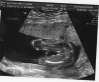 Emily 20 weeks girl.jpg