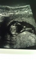 Baby arms and hands 12w3d oct 23 2012.jpg