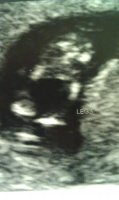 Baby legs 12w3d oct 23 2012.jpg