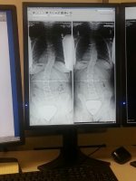 Adrian Scoliosis Xrays 11 27 2012.jpg