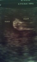 Tyler foot 18 weeks.jpg