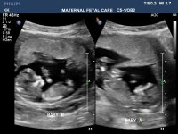 twins12weeks.jpg