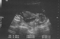 Baby A 14 week US3.jpg