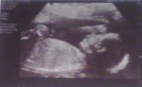 20 week 5 day scan.jpg