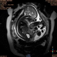 T2_pelvis_4mm.jpg