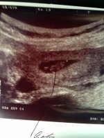 Ultrasound 7w 3days May 3rd.jpg