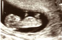 Baby_scan_week11.jpg