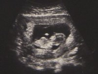 ultrasound12wks1.jpg