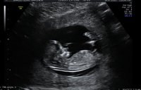 Baby At 12w1d.jpg
