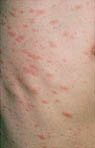 PityriasisRosea3.jpg