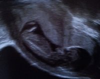 13 week scan cropped.jpg