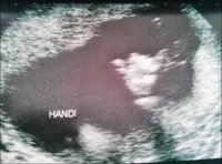 20 week scan - thumbs up.jpg