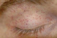petechiae.jpg