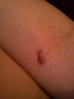 My poor arm.jpg