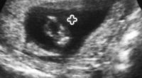 legs shot 11w5d.jpg