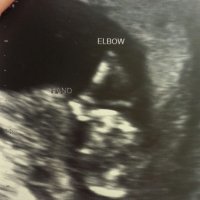 13 weeks and 2 days Hand and Elbow.jpg