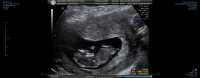 OBS NUCHAL 0001.jpg
