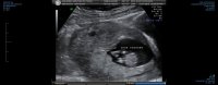 OBS NUCHAL 0003.jpg