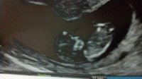 ultrasound 12 weeks 1.jpg