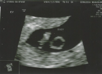 Ultrasound march42014.PNG