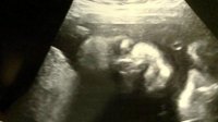 Ava 27 weeks_front view of face.jpg