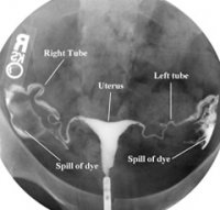 hsg-normal-anatomy.jpg