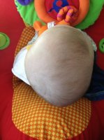 Plagiocephaly.jpg